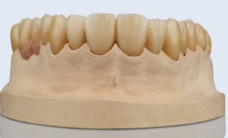 高透過性歯冠色ジルコニア